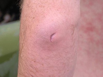 My left elbow is split to the bone.